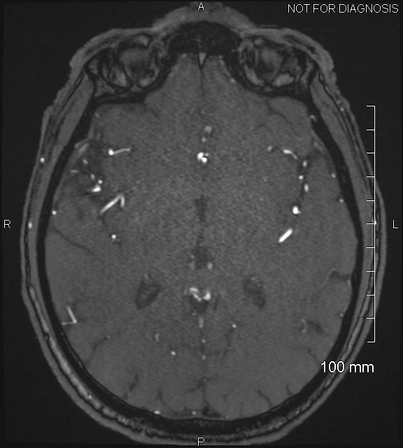 Anterior cerebral artery aneurysm (Radiopaedia 80683-94127 Axial MRA 127).jpg