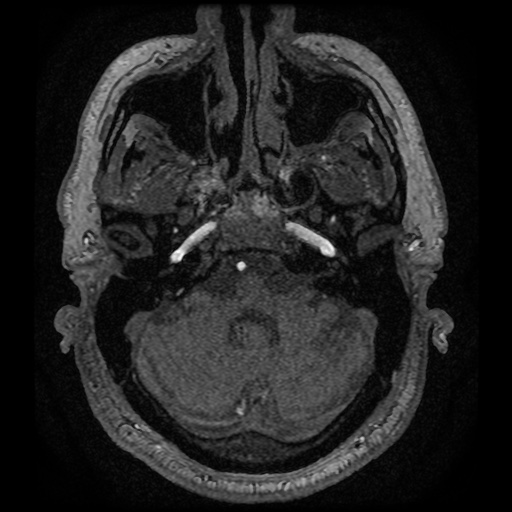 Anterior cerebral artery infarction (Radiopaedia 46794-51323 Axial MRA 20).jpg