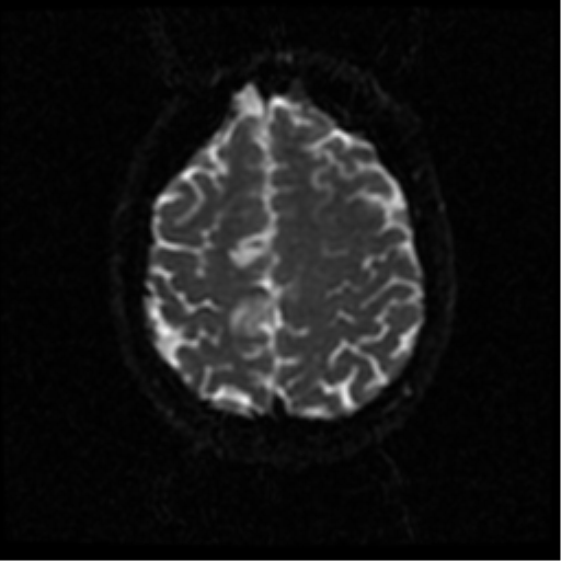 File:Anterior cerebral artery territory infarct (Radiopaedia 39327-41584 Axial DWI 46).png