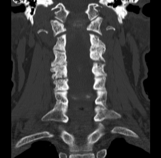 Anterior cervical postdiscectomy arthrodesis (Radiopaedia 32678-33646 Coronal bone window 32).jpg