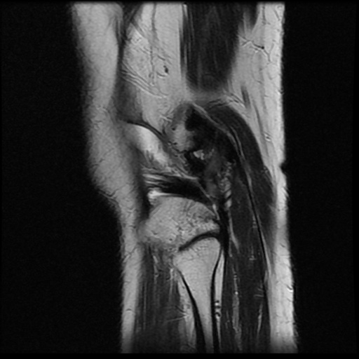 File:Anterior cruciate ligament avulsion fracture (Radiopaedia 58939-66193 Sagittal T2 4).jpg