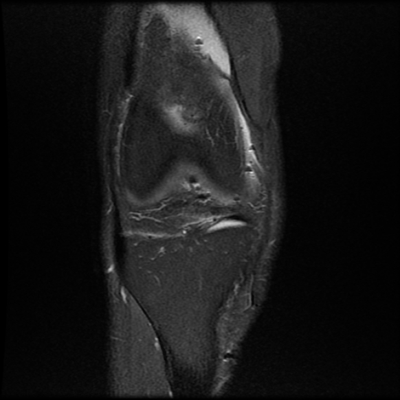 File:Anterior cruciate ligament graft tear and bucket-handle tear of medial meniscus (Radiopaedia 75867-87254 Coronal PD fat sat 7).jpg