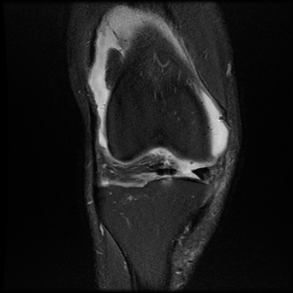 File:Anterior cruciate ligament graft tear and bucket-handle tear of medial meniscus (Radiopaedia 75867-87255 Coronal PD fat sat 9).jpg