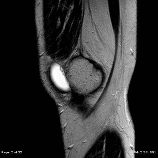 File:Anterior cruciate ligament tear (Radiopaedia 70783-80964 Sagittal T2 5).jpg