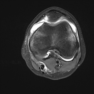 File:Anterior cruciate ligament tear - pediatric (Radiopaedia 62152-70260 Axial PD fat sat 16).jpg