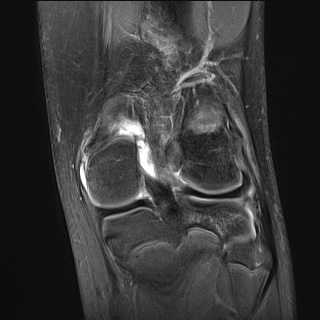 File:Anterior cruciate ligament tear - pediatric (Radiopaedia 62152-70260 Coronal PD fat sat 8).jpg