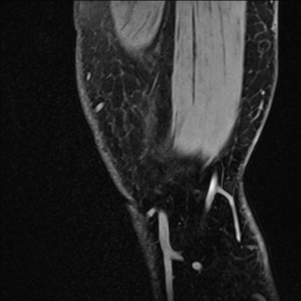 Anterior cruciate ligament tear - ramp lesion (Radiopaedia 71883-82322 Sagittal T1 vibe 136).jpg