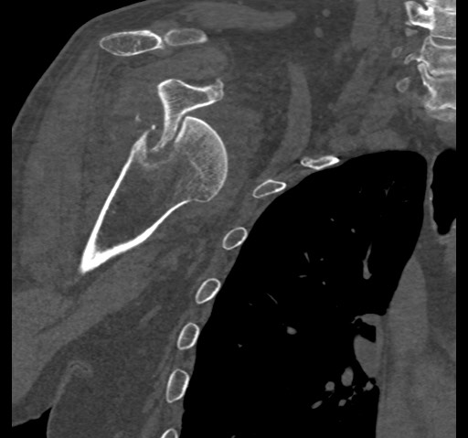 Anterior glenohumeral dislocation with Hill-Sachs lesion (Radiopaedia 62877-71249 Coronal bone window 44).jpg