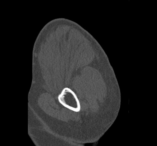 Anterior glenohumeral dislocation with Hill-Sachs lesion (Radiopaedia 62877-71249 Sagittal bone window 11).jpg