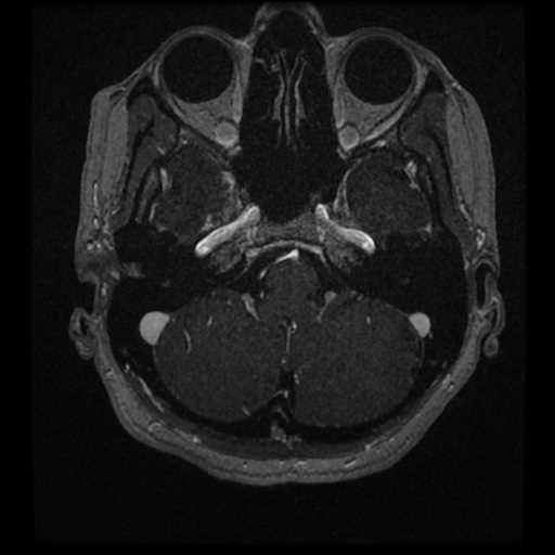 Anterior inferior cerebellar artery vascular loop - type II (Radiopaedia 70991-81209 Axial T1 C+ 66).jpg