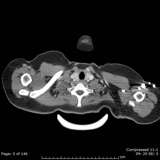 File:Anterior mediastinal B cell Lymphoma (Radiopaedia 50677-56114 A 3).jpg
