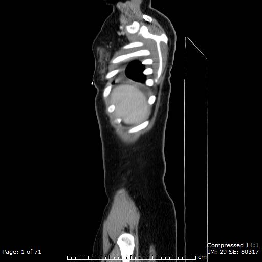 File:Anterior mediastinal B cell Lymphoma (Radiopaedia 50677-56114 C 1).jpg