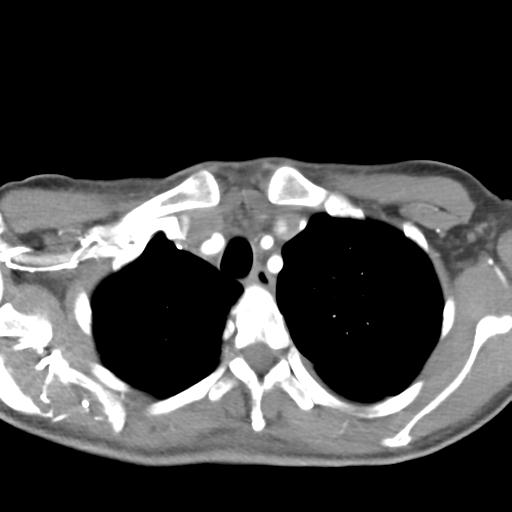 File:Anterior mediastinal lymphoma (Radiopaedia 29556-30061 C 10).jpg