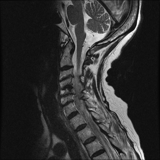 File:Anterior spinal artery syndrome (Radiopaedia 46335-50750 A 4).png
