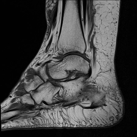 File:Anterior talofibular ligament injury - rupture with soft-tissue impingement (Radiopaedia 38765-40928 Sagittal PD 8).jpg