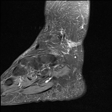 File:Anterior talofibular ligament injury - rupture with soft-tissue impingement (Radiopaedia 38765-40928 Sagittal PD fat sat 1).jpg