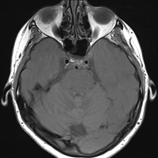 File:Anterior temporal encephalocele (Radiopaedia 82624-96808 Axial T1 11).jpg