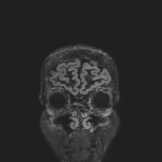Anterior temporal encephalocele (Radiopaedia 82624-96808 Coronal FLAIR 4).jpg