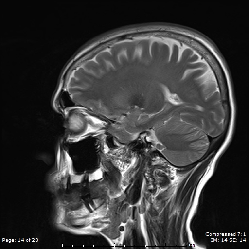 File:Anterior temporal lobe perivascular space (Radiopaedia 88283-104914 Sagittal T2 14).jpg