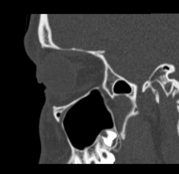 Antrochoanal polyp (Radiopaedia 33984-35202 Sagittal bone window 64).jpg