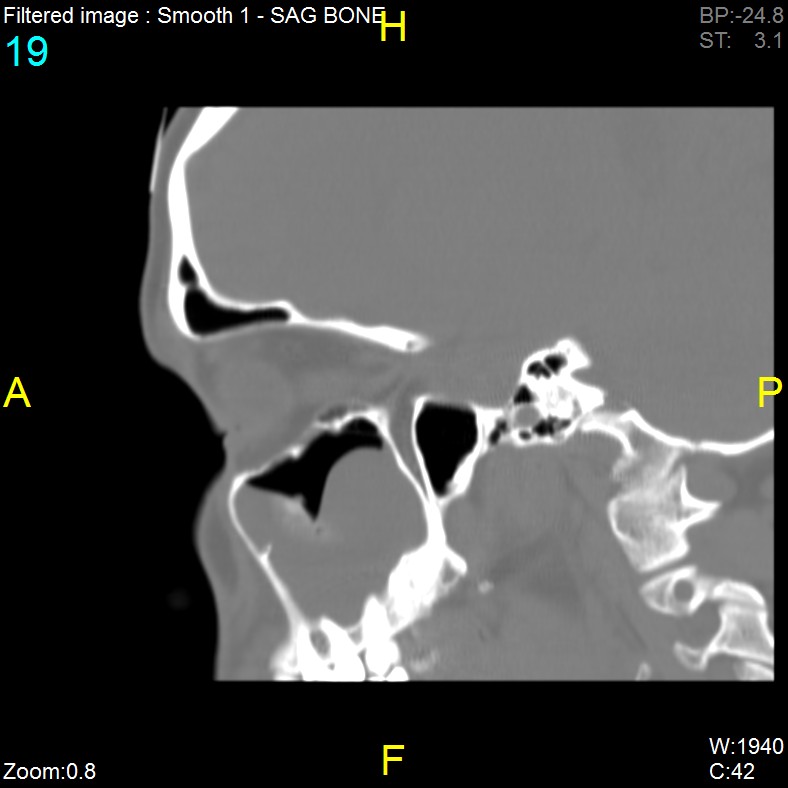 Antrochoanal polyp (Radiopaedia 65101-74094 Sagittal bone window 19).jpg