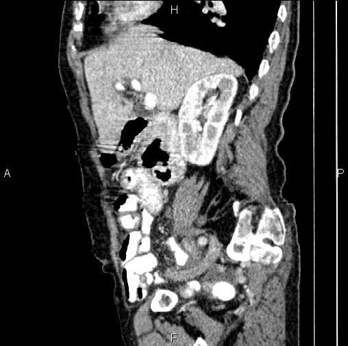 File:Aortic aneurysm and Lemmel syndrome (Radiopaedia 86499-102554 D 30).jpg