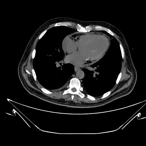 Aortic arch aneurysm (Radiopaedia 84109-99365 Axial non-contrast 170).jpg