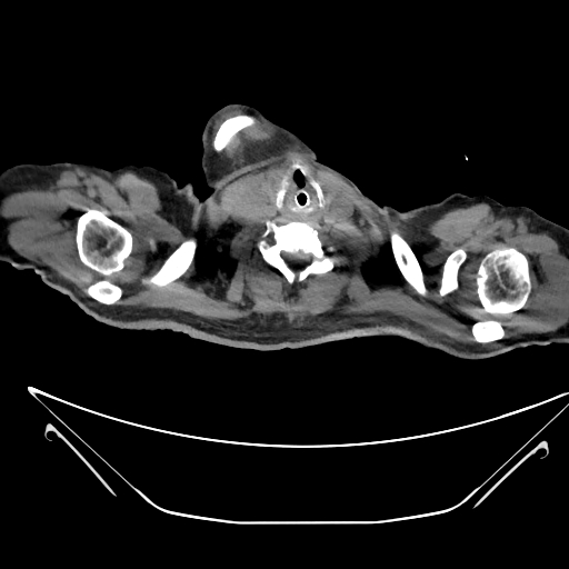 File:Aortic arch aneurysm (Radiopaedia 84109-99365 Axial non-contrast 2).jpg