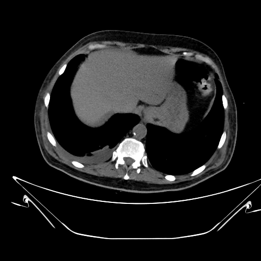 Aortic arch aneurysm (Radiopaedia 84109-99365 Axial non-contrast 244).jpg