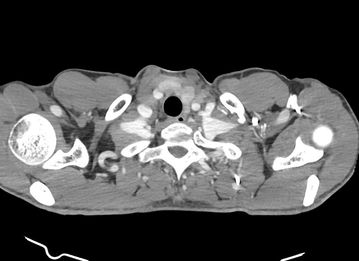 File:Aortic coarctation with aneurysm (Radiopaedia 74818-85828 A 181).jpg