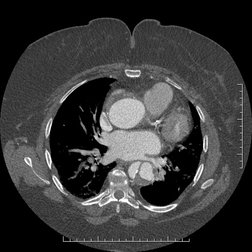File:Aortic dissection- Stanford A (Radiopaedia 35729-37268 A 49).jpg