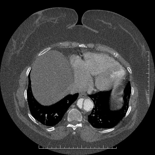 Aortic dissection- Stanford A (Radiopaedia 35729-37268 B 10).jpg