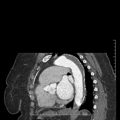 File:Aortic dissection- Stanford A (Radiopaedia 35729-37268 D 12).jpg