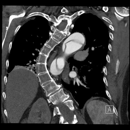 Aortic dissection (CTPA) (Radiopaedia 75506-86750 B 51).jpg