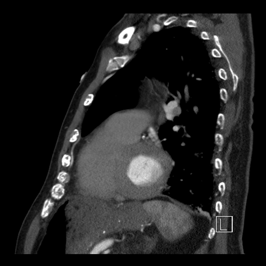 File:Aortic dissection (CTPA) (Radiopaedia 75506-86750 C 72).jpg
