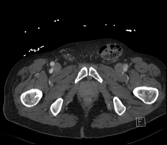 Aortic dissection (CTPA) (Radiopaedia 75506-86750 E 156).jpg