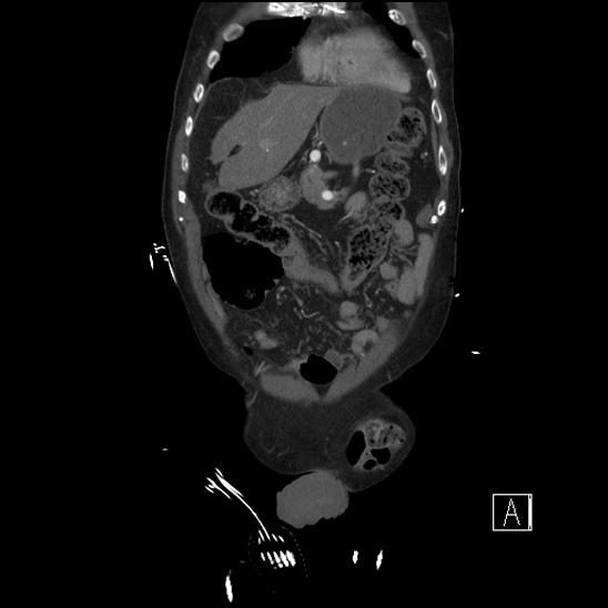 File:Aortic dissection (CTPA) (Radiopaedia 75506-86750 F 12).jpg
