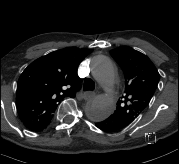 File:Aortic dissection (CTPA) (Radiopaedia 75506-86751 Axial C+ CTPA 48).jpg