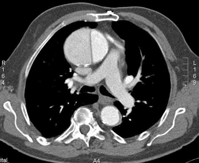 File:Aortic dissection - Stanford A (Radiopaedia 8886).jpg
