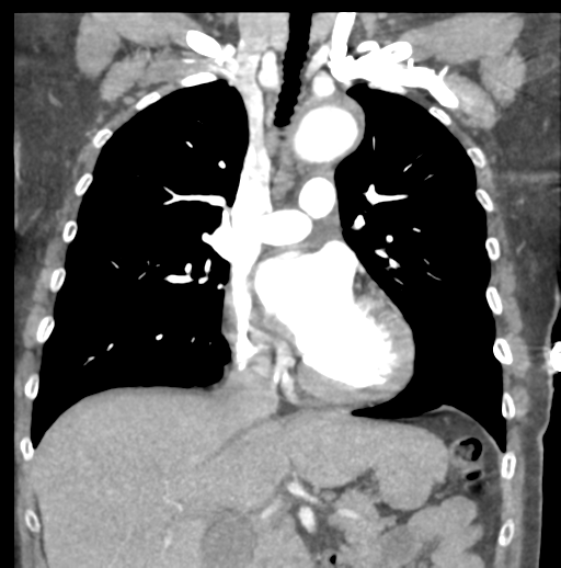 File:Aortic dissection - Stanford type B (Radiopaedia 50171-55512 B 38).png