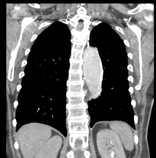 File:Aortic dissection - Stanford type B (Radiopaedia 50171-55512 B 64).png
