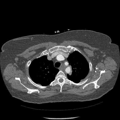 Aortic dissection - Stanford type B (Radiopaedia 88281-104910 A 11).jpg
