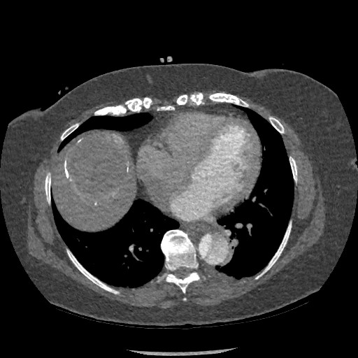 Aortic dissection - Stanford type B (Radiopaedia 88281-104910 A 61).jpg
