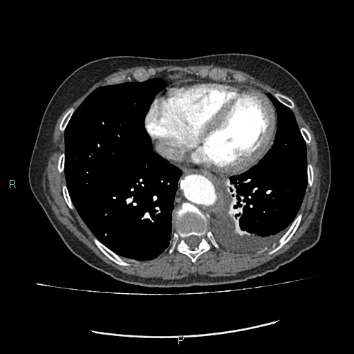 File:Aortic dissection extended to lusory artery (Radiopaedia 43686-47136 B 10).jpg