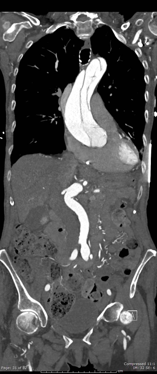 Aortic dissection with extension into aortic arch branches (Radiopaedia 64402-73204 A 31).jpg