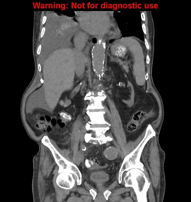 Aortic graft infection (Radiopaedia 44979-48907 non-contrast 29).jpg