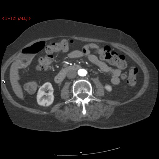 Aortic intramural hematoma (Radiopaedia 27746-28001 A 121).jpg