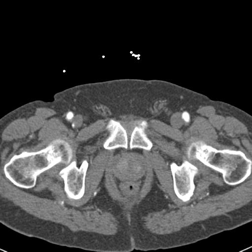 Aortic intramural hematoma (Radiopaedia 31139-31838 B 171).jpg