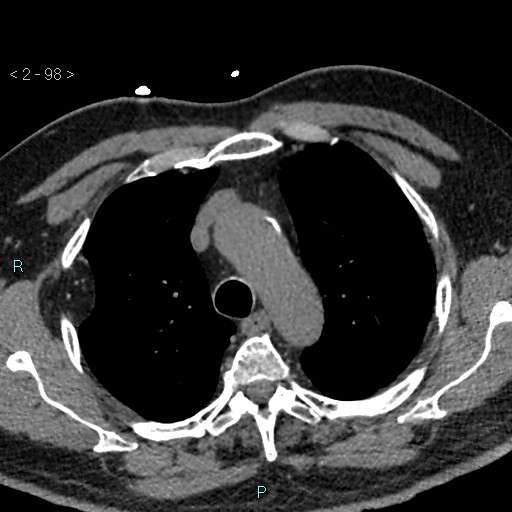 Aortic intramural hematoma (Radiopaedia 48463-53380 Axial non-contrast 44).jpg