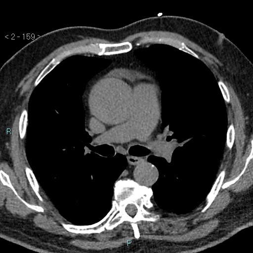 File:Aortic intramural hematoma (Radiopaedia 48463-53380 Axial non-contrast 71).jpg